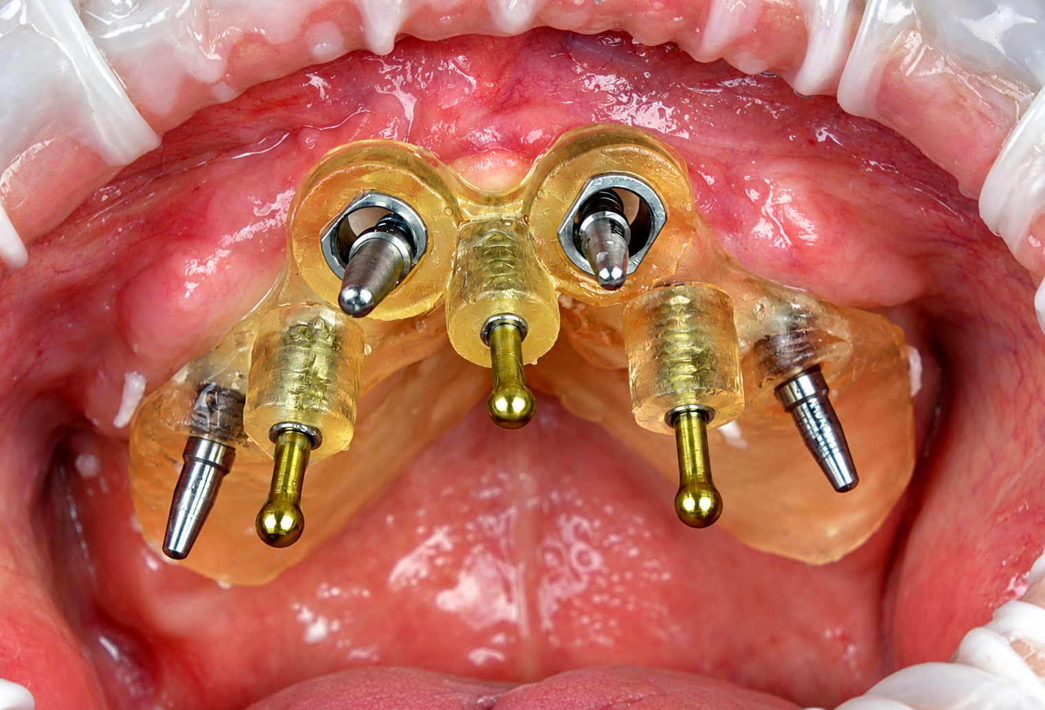 Dental Implants 1