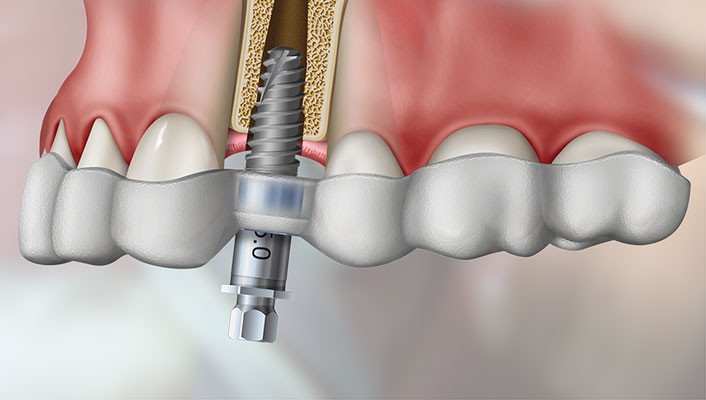 Dental Implants 2